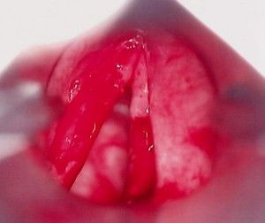 Предпосылками к развитию рака горла являются частые и затяжные тонзиллиты, отиты, фарингиты, а также хронические воспалительные заболевания зубов, носоглотки, голосовых связок